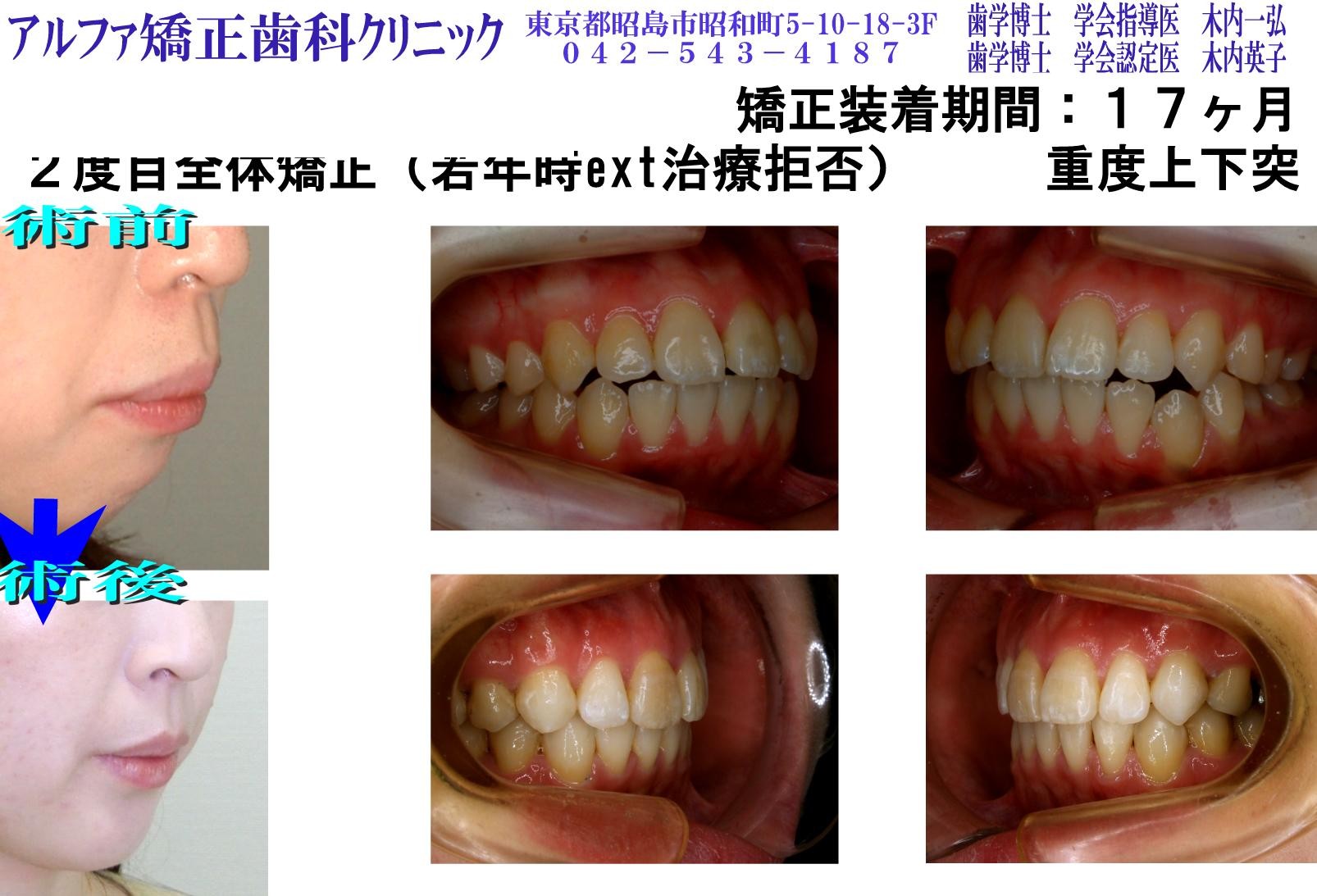 重度上下突（２度目矯正）の症例写真