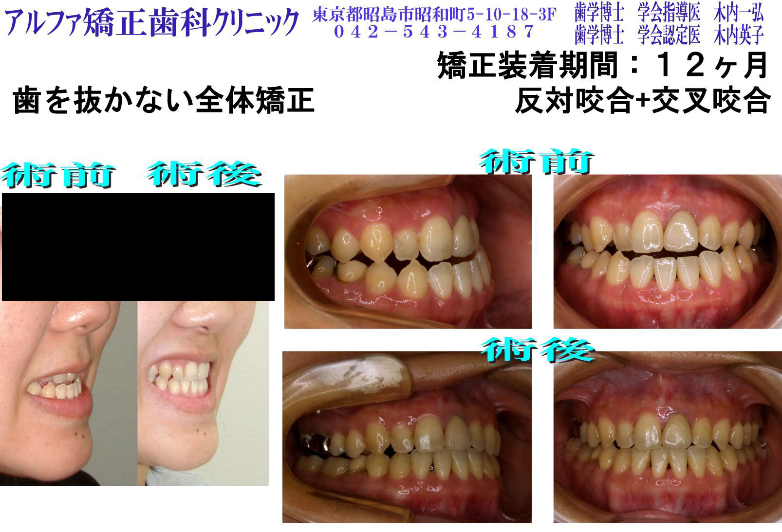 反対咬合・交叉咬合の症例写真