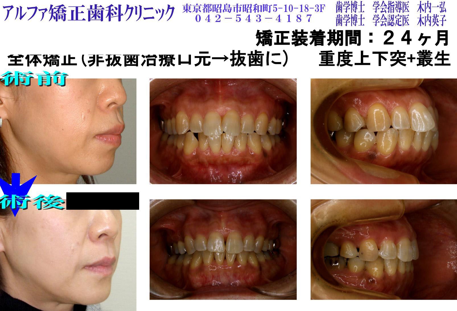 重度上下突・叢生の症例写真
