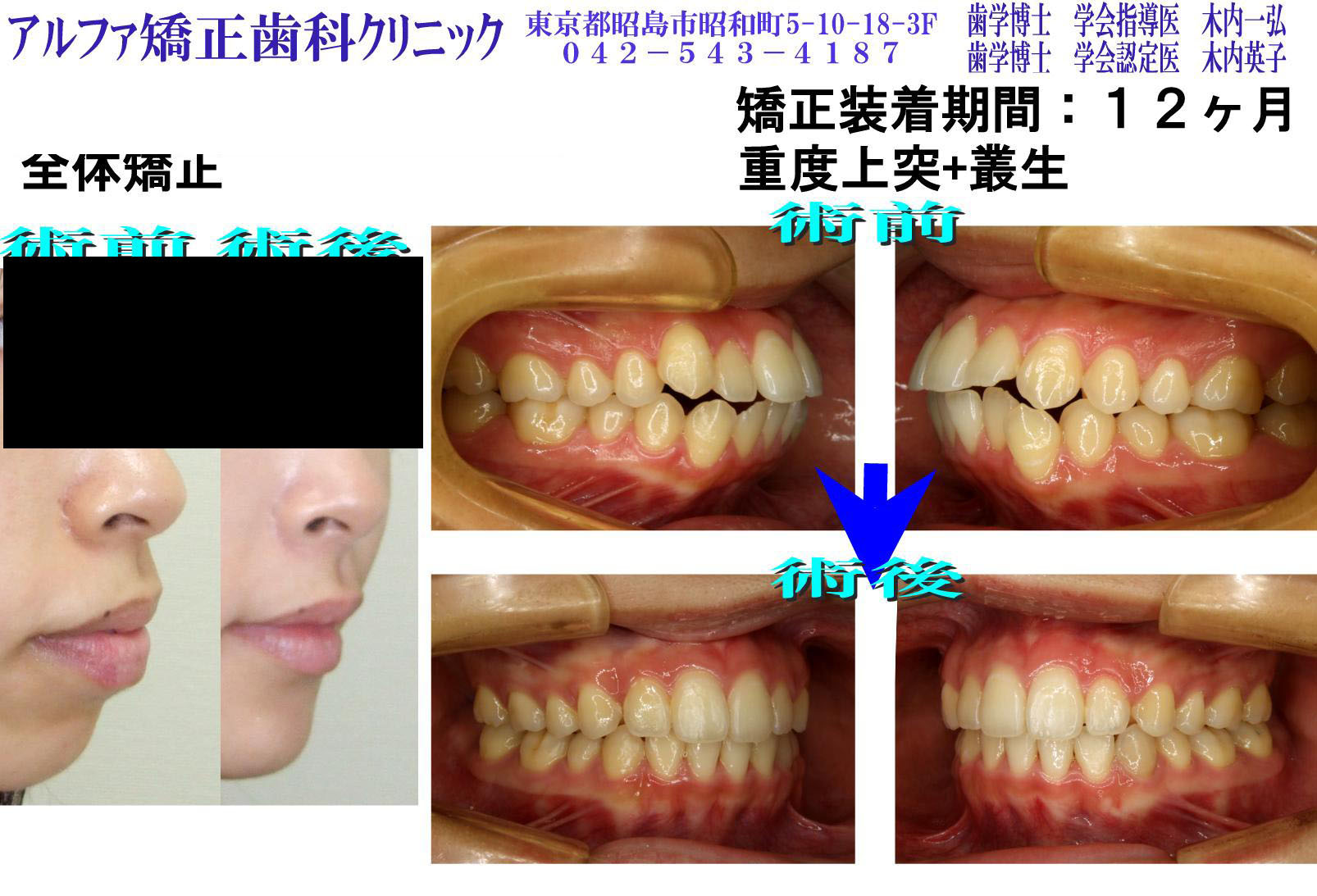 重度上突・叢生の症例写真