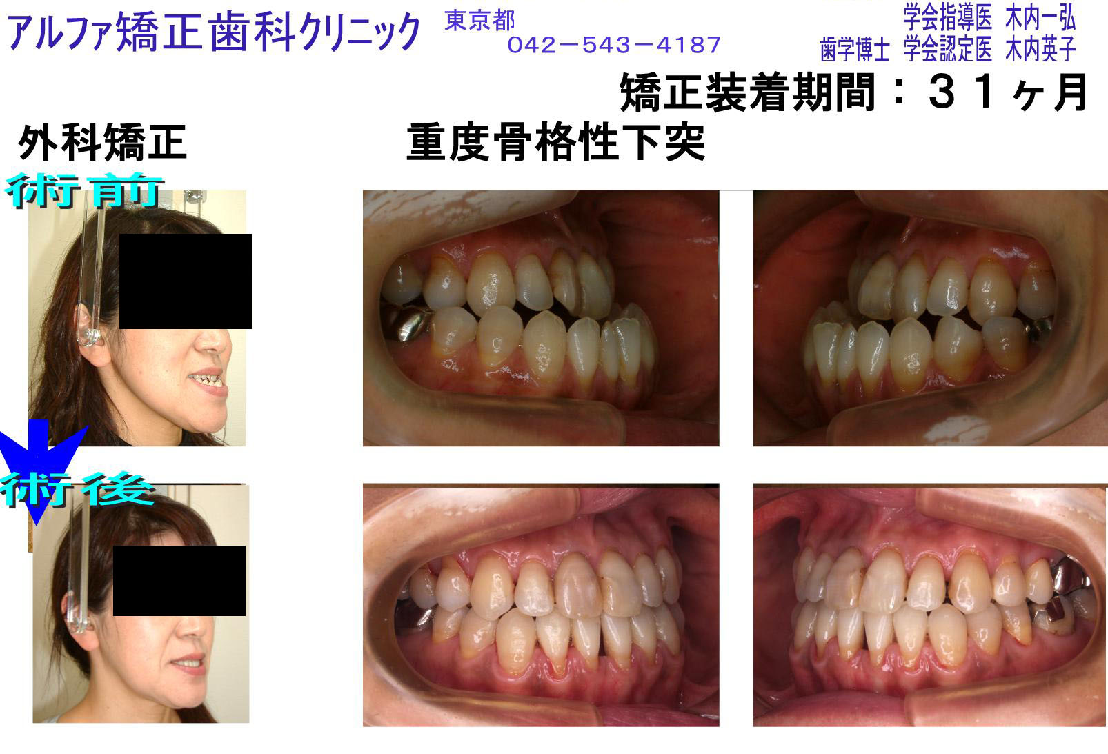 重度骨格性下突（外科矯正）の症例写真