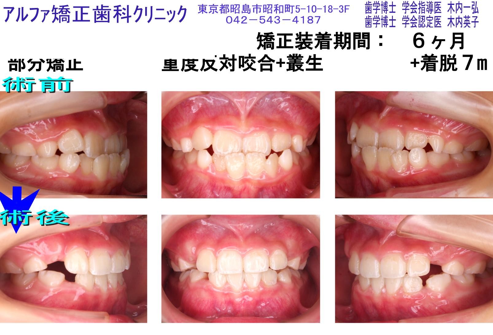 重度反対咬合・叢生の症例写真