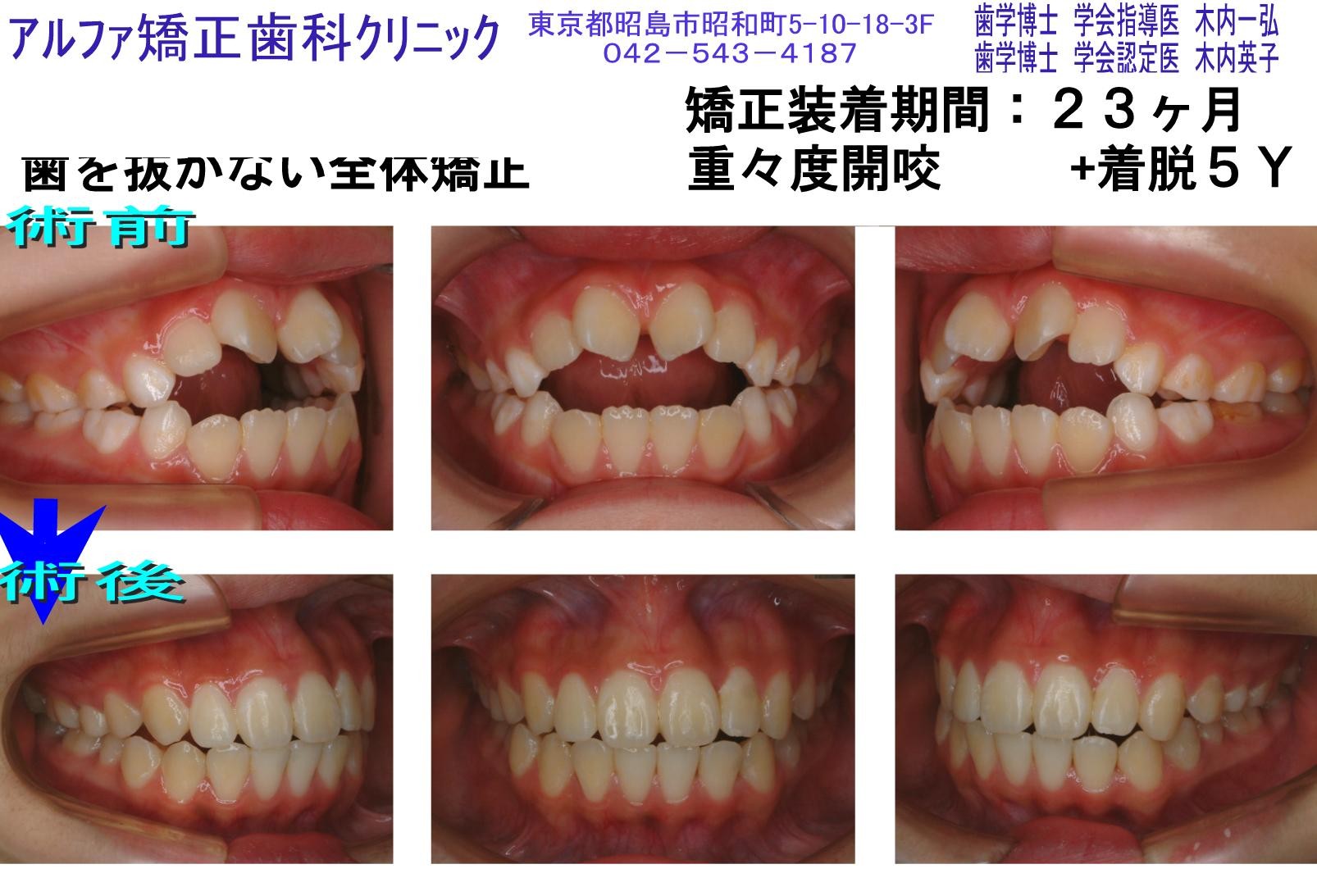 重々度開咬の症例写真