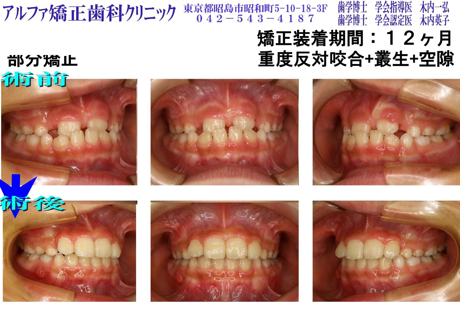 重度反対咬合・叢生・空隙の症例写真