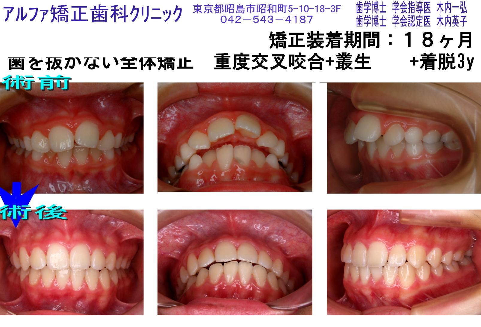 重度交叉咬合・叢生の症例写真