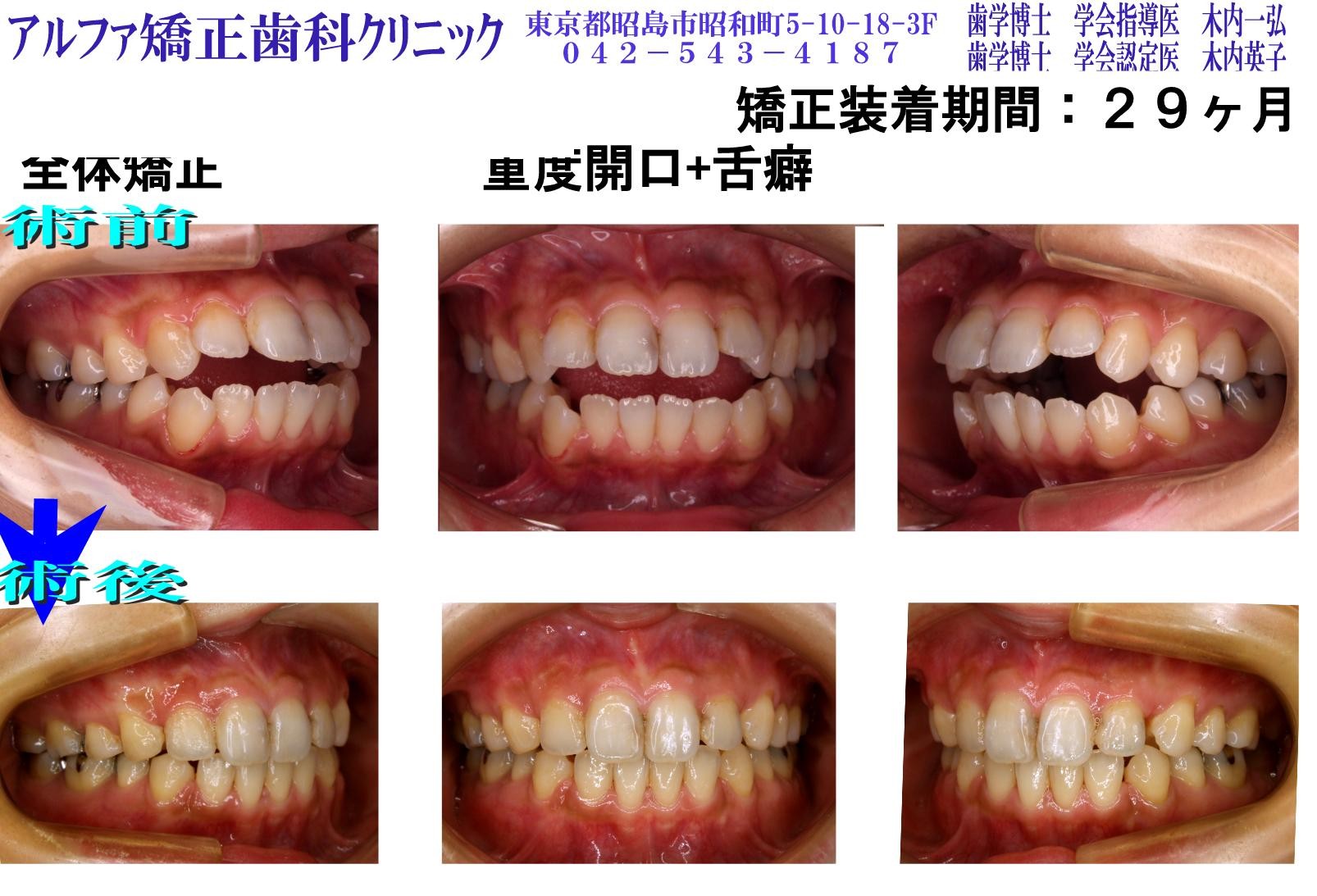 重度開口・舌癖の症例写真