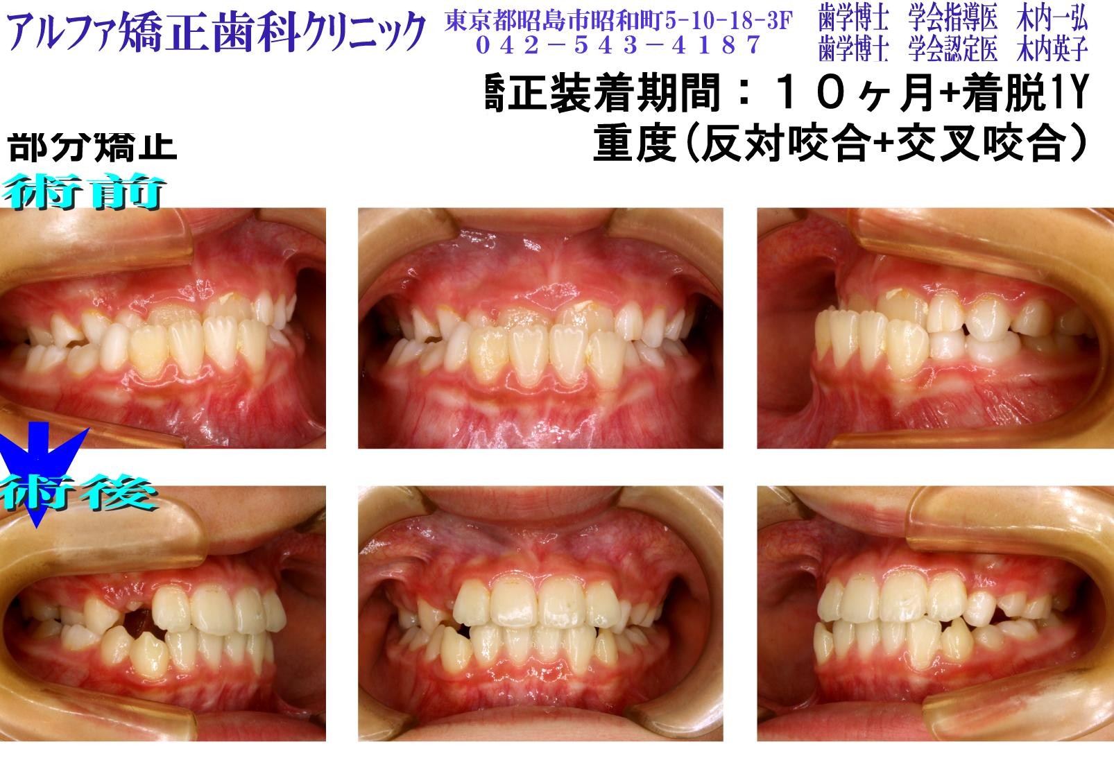 重度反対咬合・交叉咬合の症例写真