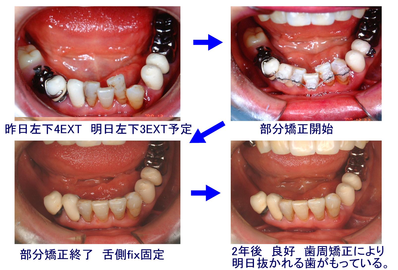 部分矯正（歯周矯正併用）の症例写真