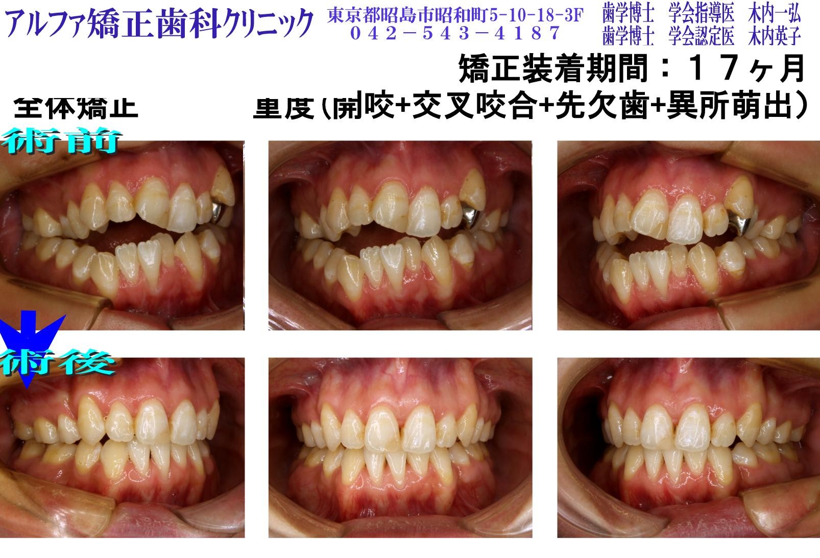 重度開咬・交叉咬合・先欠歯・異所萌出の症例写真