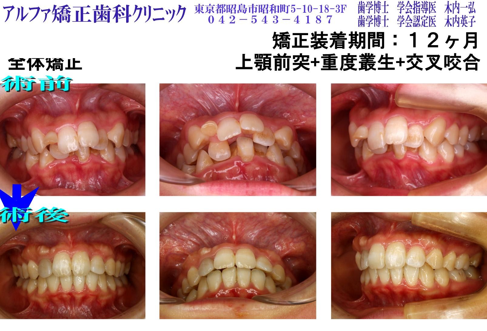 上顎前突・重度叢生・交叉咬合の症例写真