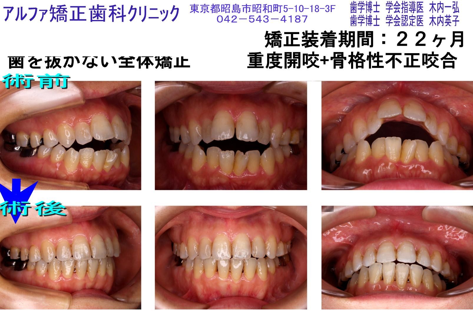 重度開咬・骨格性不正咬合の症例写真