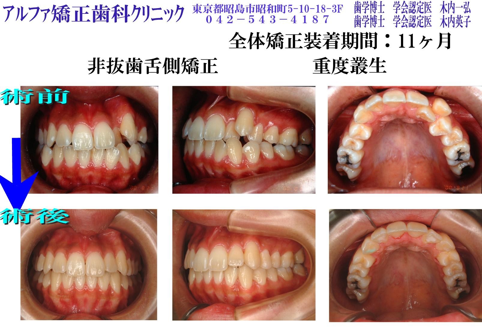 重度叢生の症例写真