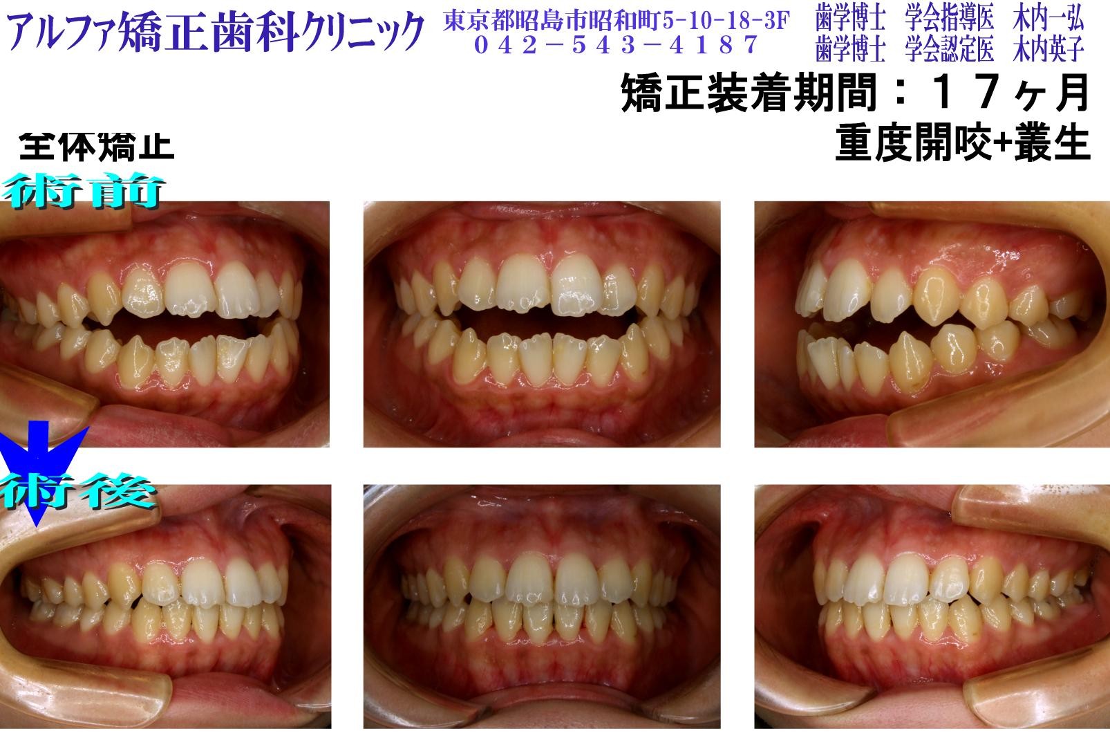 重度開咬・叢生の症例写真
