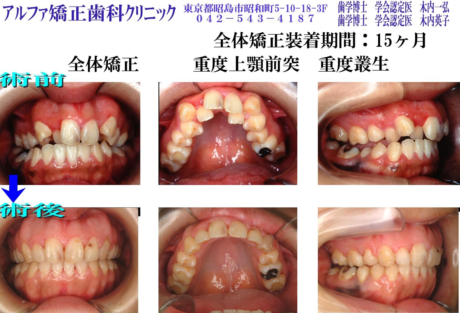 重度上顎前突・重度叢生の症例写真