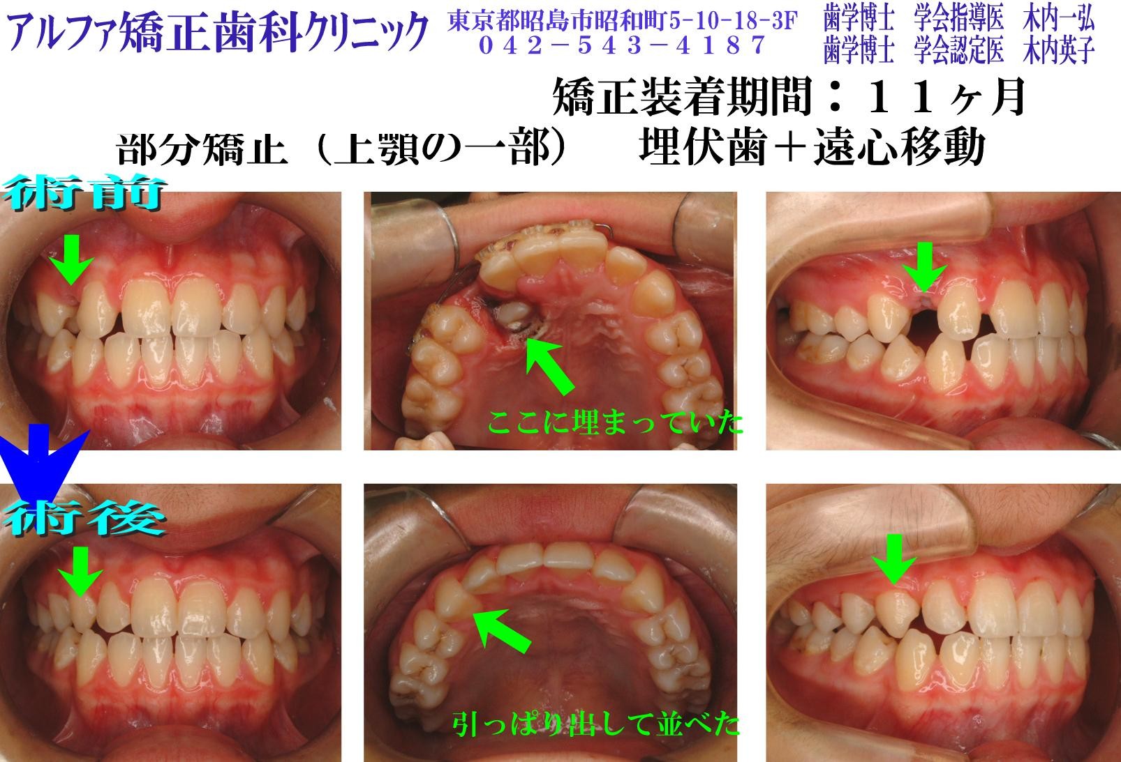埋伏歯・遠心移動の症例写真