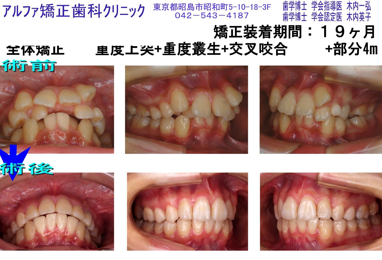 重度上突・重度叢生・交叉咬合の症例写真